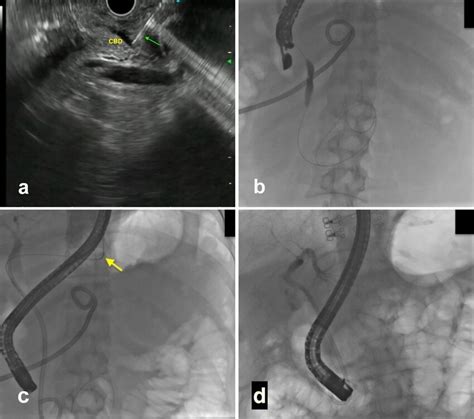 Eus Guided Rendezvous A Puncture Of The Bile Duct With 19g Needle