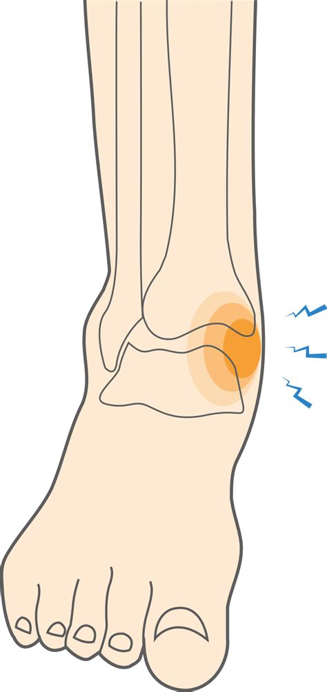 What Is A Medial Ankle Sprain And How To Recover From It Upswing Health