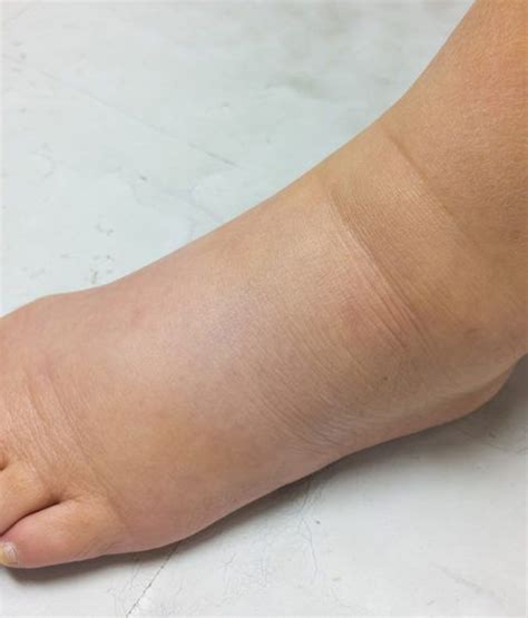 Pin By Brenda Mcmillion On Lymphadema Swollen Legs Swellings