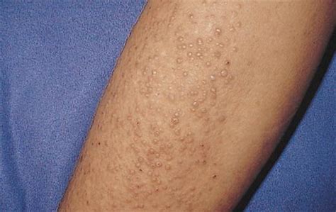 Lichen Amyloidosis Associated With Atopic Dermatitis Clinical