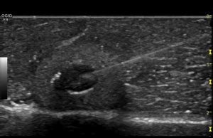 CP Advanced Imaging Thyroid Biopsy