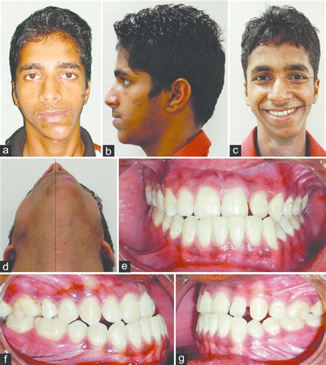 A Pretreatment Frontal Photograph Illustrating Facial Asymmetry B