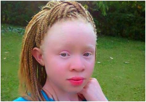 Nic Pledges To Continue Supporting Children With Albinism