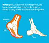 A common cause of bone spurs is osteoarthritis. Natural Bone Spur Treatments - Abundant Life Family ...