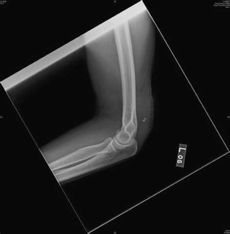 Lateral X Ray Radio Paque Glass Foreign Bodies Proximal To The Elbow