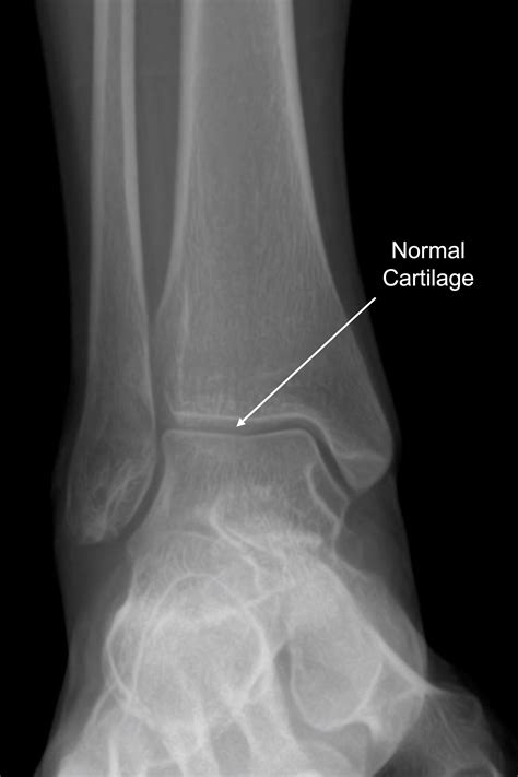 Ankle Arthritis — Daniel Bohl Md Midwest Orthopaedics At Rush