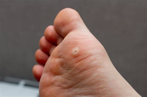 What You Should Know About Plantar Warts — River Podiatry I The Best Foot And Ankle Care In Ny Nj