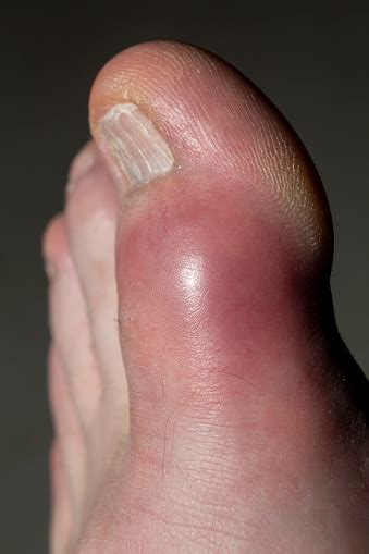 Gout In The Left Big Toe Stock Photo Download Image Now Foot Gout
