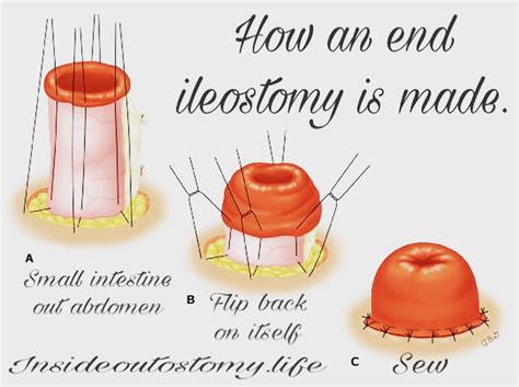 Ostomy Awareness Insideoutlet