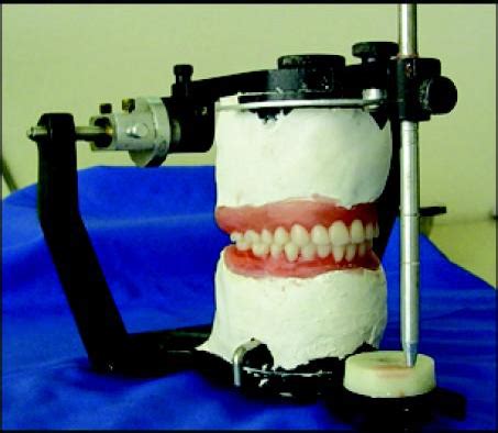 The aim of fabricating a duplicate denture is to transfer the contour of the old dentures to the new dentures, so that the neuromuscular coordination of the patient is preserved. Replacing Existing Dentures by Copy-Denture Technique for ...