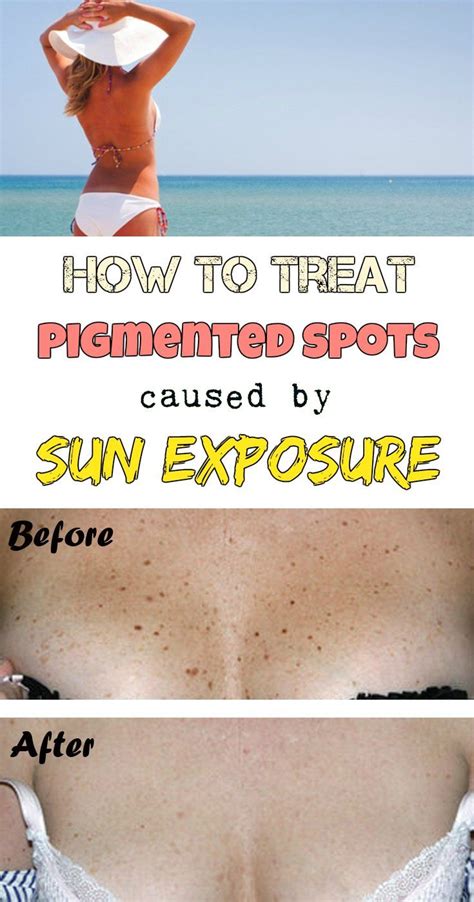 How To Treat Pigmented Spots Caused By Sun Exposure Beauty