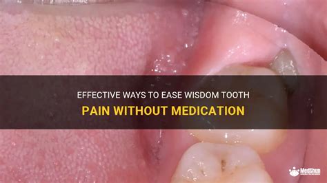 Effective Ways To Ease Wisdom Tooth Pain Without Medication Medshun