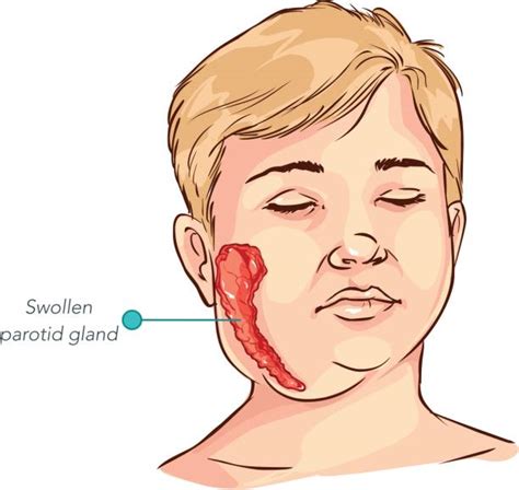 Images Of Mumps Illustrations Royalty Free Vector Graphics And Clip Art