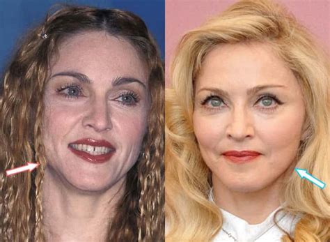 Did Madonna EVER Have Plastic Surgery Before After 2021