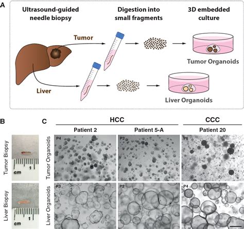PDF Organoid Models Of Human Liver Cancers Derived From Tumor Needle