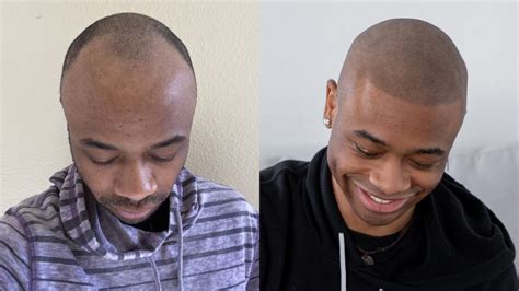 What Causes An Uneven Hairline And How Can I Fix It Scalp Micro Usa