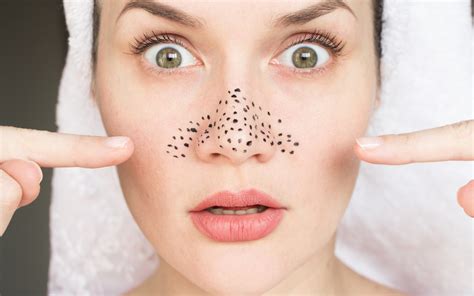 ≡ How To Get Rid Of Blackheads 》 Her Beauty