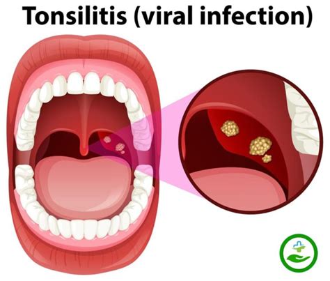 Tonsillitis Causessymptomstreatment And Home Remedies Medico Iq