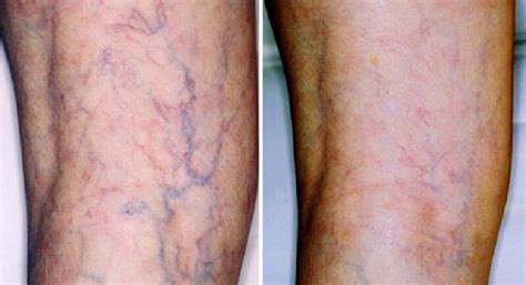 What Are Thread Veins And How Can They Be Treated My Health Line
