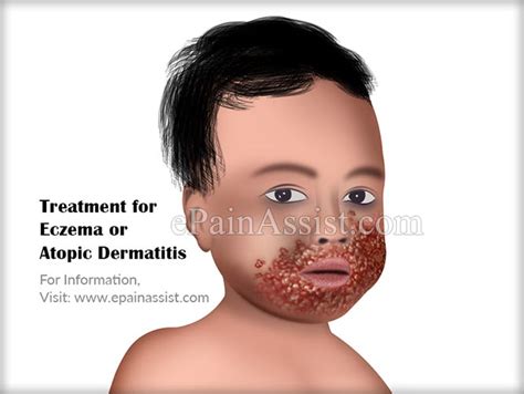 Atopic dermatitis can also impact family life. Eczema or Atopic Dermatitis|Causes|Symptoms|Treatment|Home ...