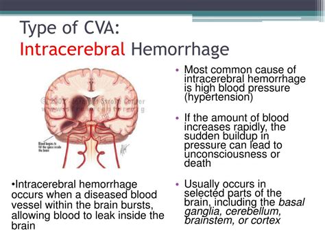 Ppt Cerebrovascular Accident Stroke Powerpoint Presentation Free