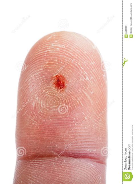 Bleeding Injured Fingertip Stock Image Image Of Damaged 85004831