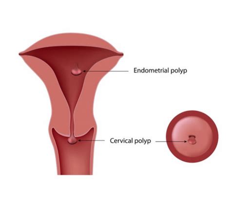 Cervical Polyps Healthify