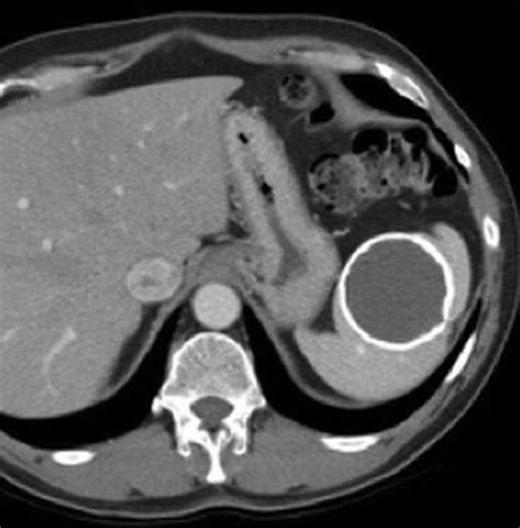 Calcified Splenic Lesions Pattern Recognition Approach On Ct With