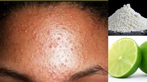 How To Get Rid Of Small Bumps On Face And Forehead Simple Home Remedy