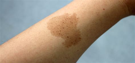 Birthmarks Pigmented As Related To Skin Cancer Pictures