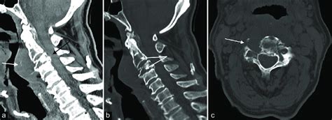 A Plain Ct Cervical Spine Cervical Spine Tumor At C2 C3 Levels It