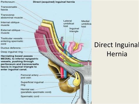Laparoscopic Anatomy Of Inguinal Hernia