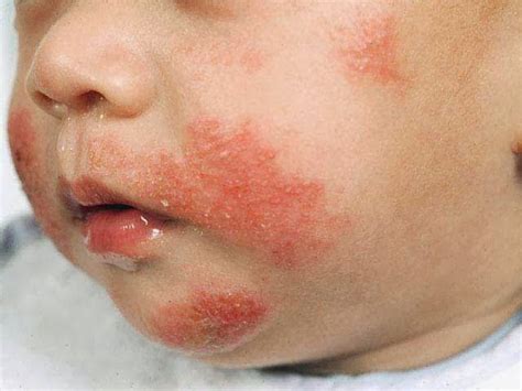 Sweet Home Ekseem Face Rash Remedies Rash On Face Eczema Causes