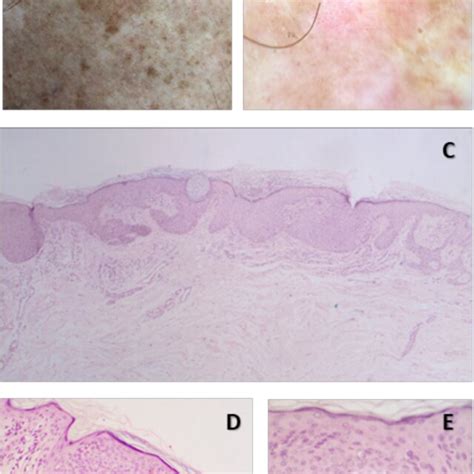 Pdf Clinical Dermoscopic And Histopathologic Findings Of