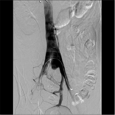 An Interventional Radiology Angiogram And Venogram On Day 1 Showed A