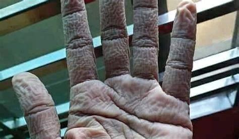 Image of healthcare professional's wrinkled hand after 10 hours of duty ...