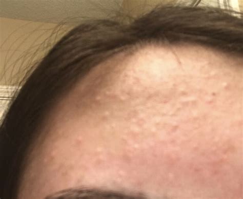 Is This Acne Or Malassezia Folliculitis Pictures Included General