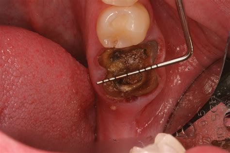 Bone Grafting After Tooth Removal Why When And What To Use Dental