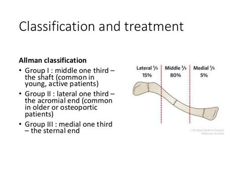 Allman Classification Of Clavicle Fracture