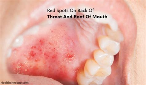 Red Spots On Back Of Throat And Roof Of Mouth Causes Diagnosis