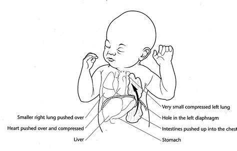 Congenital Diaphragmatic Hernia Cdh Ohio Fetal Medicine Collaborative