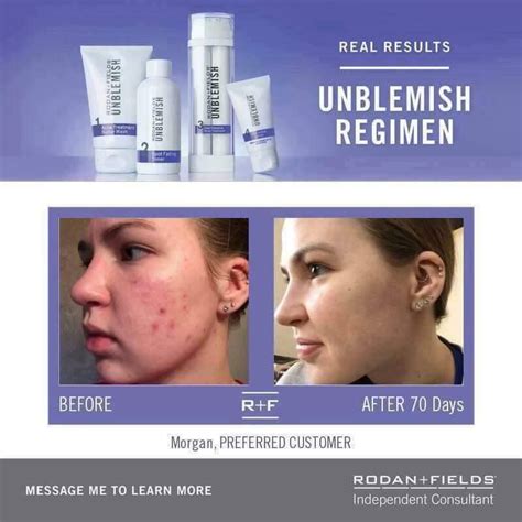 Rodanfields Cleans Up Your Acne Including Cystic Acne And We Offer