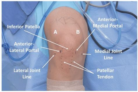 Principles Of Knee Arthroscopy Musculoskeletal Key