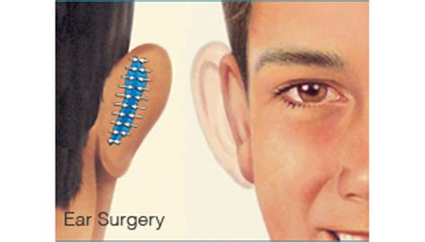 Cosmetic Ear Surgery Brigham And Womens Hospital