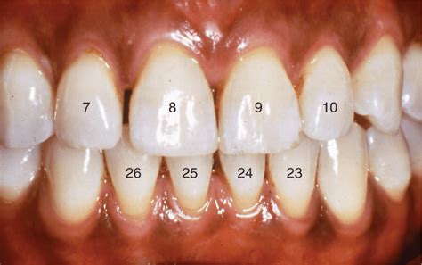 General Description Of Incisors Pocket Dentistry