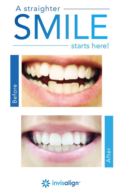 Smile Assessment Invisalign Invisalign Dental Insurance Dental