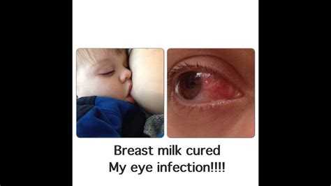 Breask Milk Cured My Eye Infection Youtube