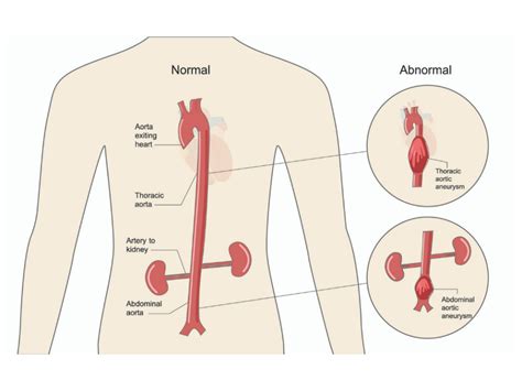 Vascular Education My Vascular Health