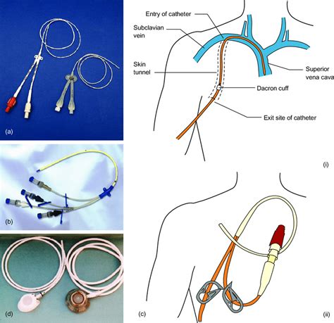 5 A Types Of Peripherally Inserted Central Catheter B