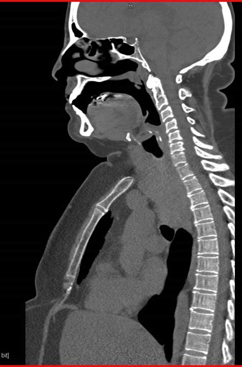 Thyroid Goiter Displaces The Trachea In 3d Chest Case Studies